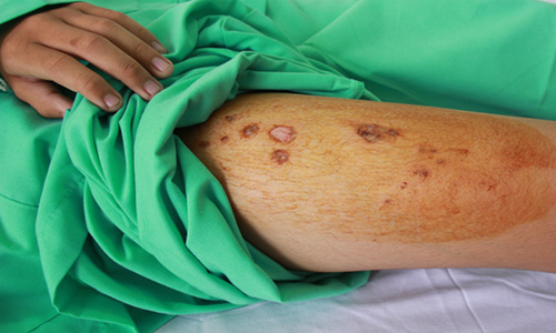 Vết cháy xém trên đùi em Vũ do bị điện giật. Ảnh: Hoàng Nam